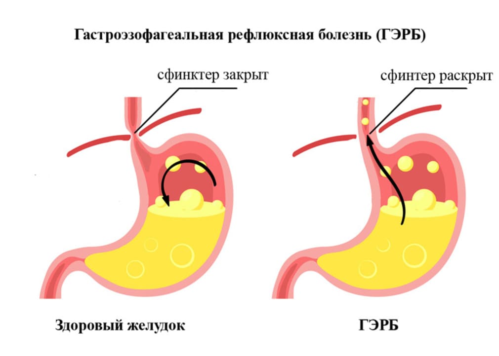 Питание при изжоге: общие рекомендации, полезные продукты, примерное меню