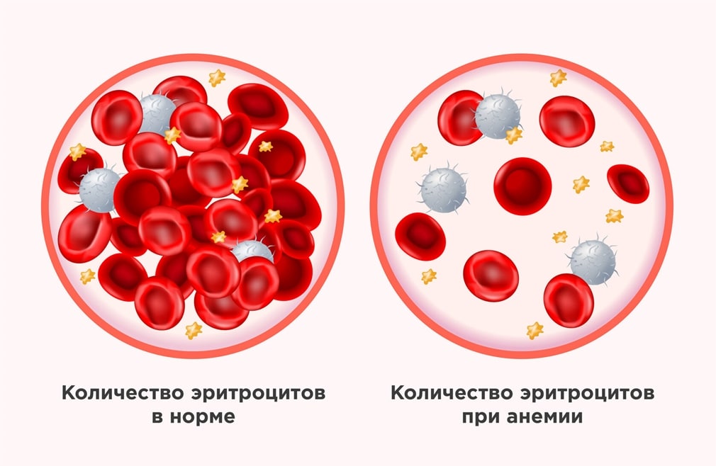 Виды анемии и их классификации